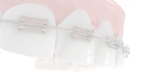 tipuri de bracketi centrul ortodontic cluj