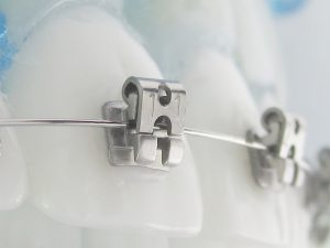aparat dentar metalic autoligaturant