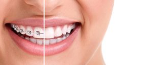 fapte si mituri despre ortodontie