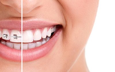 Fapte si mituri despre ortodontie